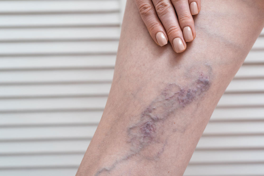 Chronic Venous Insufficiency