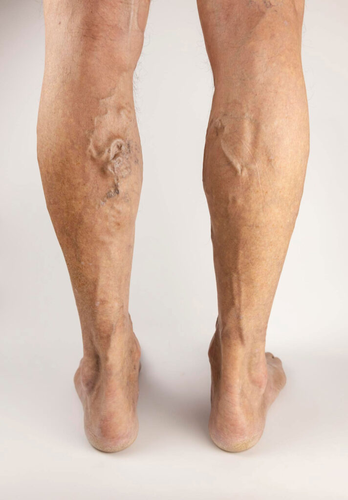 Varicose vein