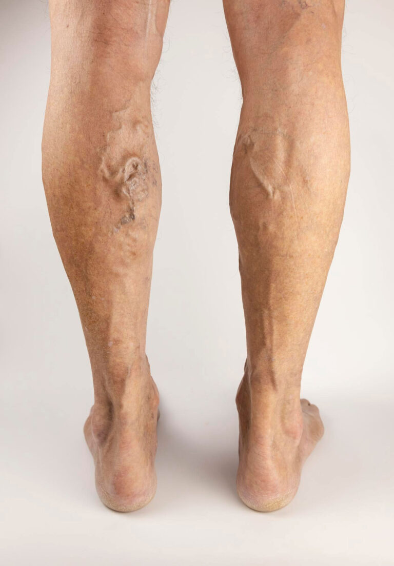 Varicose vein