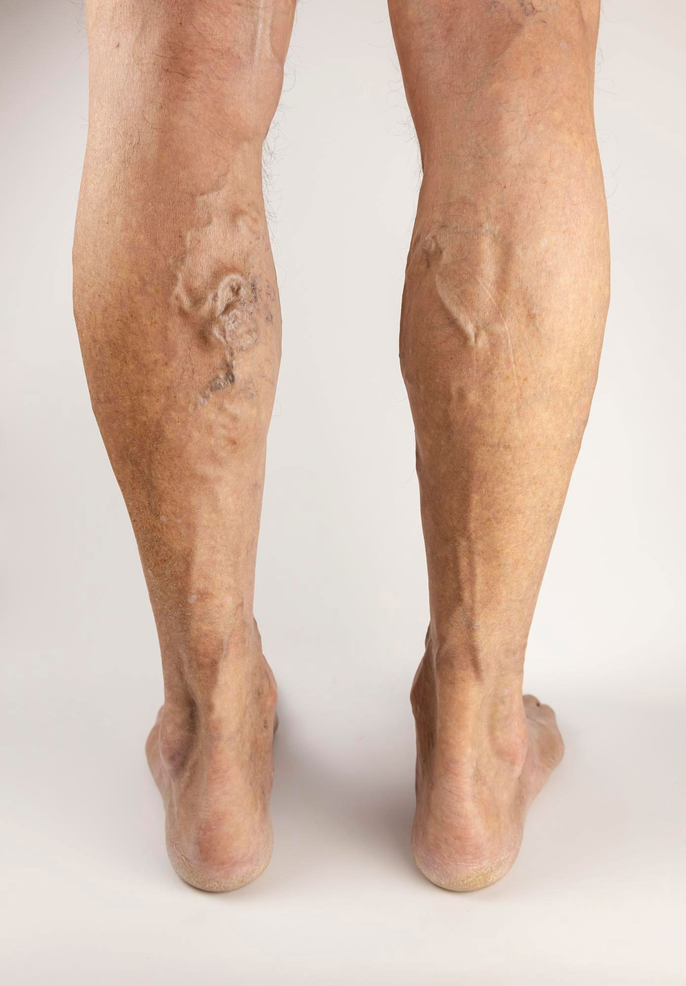 Read more about the article Do You Really Need Treatment for Varicose Veins, or Can They Be Safely Left Alone?