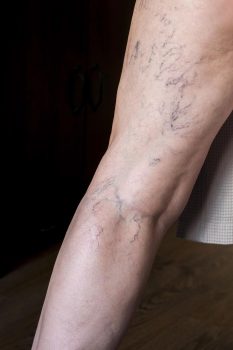 Chronic Venous Insufficiency