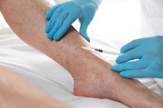 Sclerotherapy