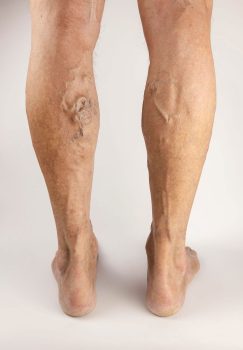Varicose vein